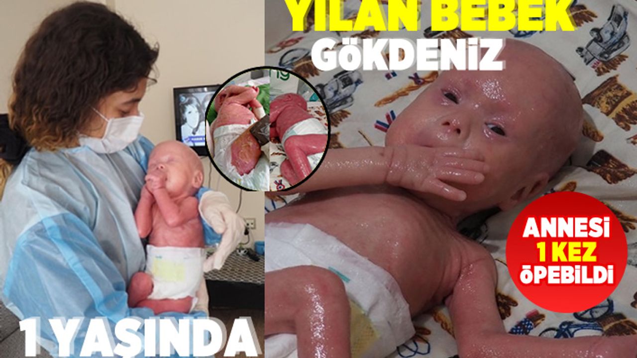 Yılan bebek Gökdeniz 1 yaşına girdi! Günde 1 kilo vazelin 2 tüp krem sürüyorlar!