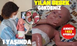 Yılan bebek Gökdeniz 1 yaşına girdi! Günde 1 kilo vazelin 2 tüp krem sürüyorlar!