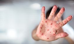 Kızamık yeniden hortladı: Son 25 yılın en yüksek seviyesi!