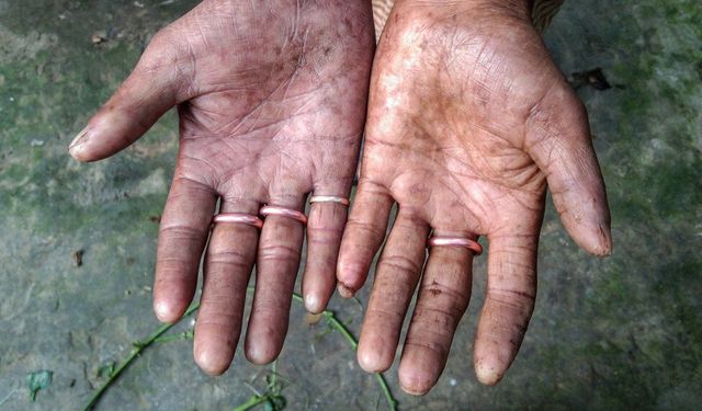 Parmak İzi Olmayan Aile: Sarkerlerin Biyometrik Mücadelesi