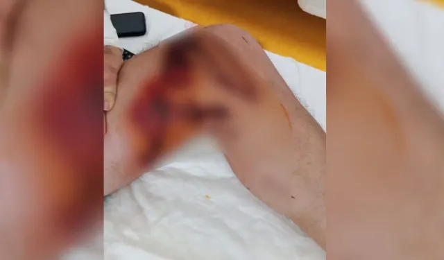 Lavabo Açıcı Kazası: Vücudunun Yüzde 15'i Yandı