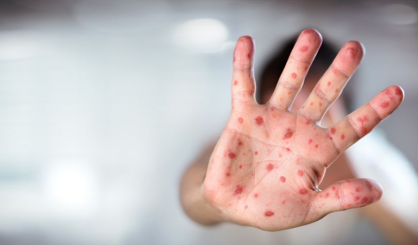 Kızamık yeniden hortladı: Son 25 yılın en yüksek seviyesi!