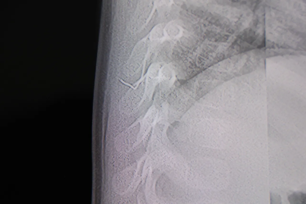 Boylesini Ne Gorduk Ne Duyduk 1 Yasindaki Bebegin Sirtindan Zimba Teli Cikti 1767316 202601300923 20260130092340 1